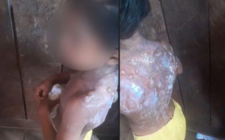 Padrasto é preso após queimadura grave em criança de 6 anos